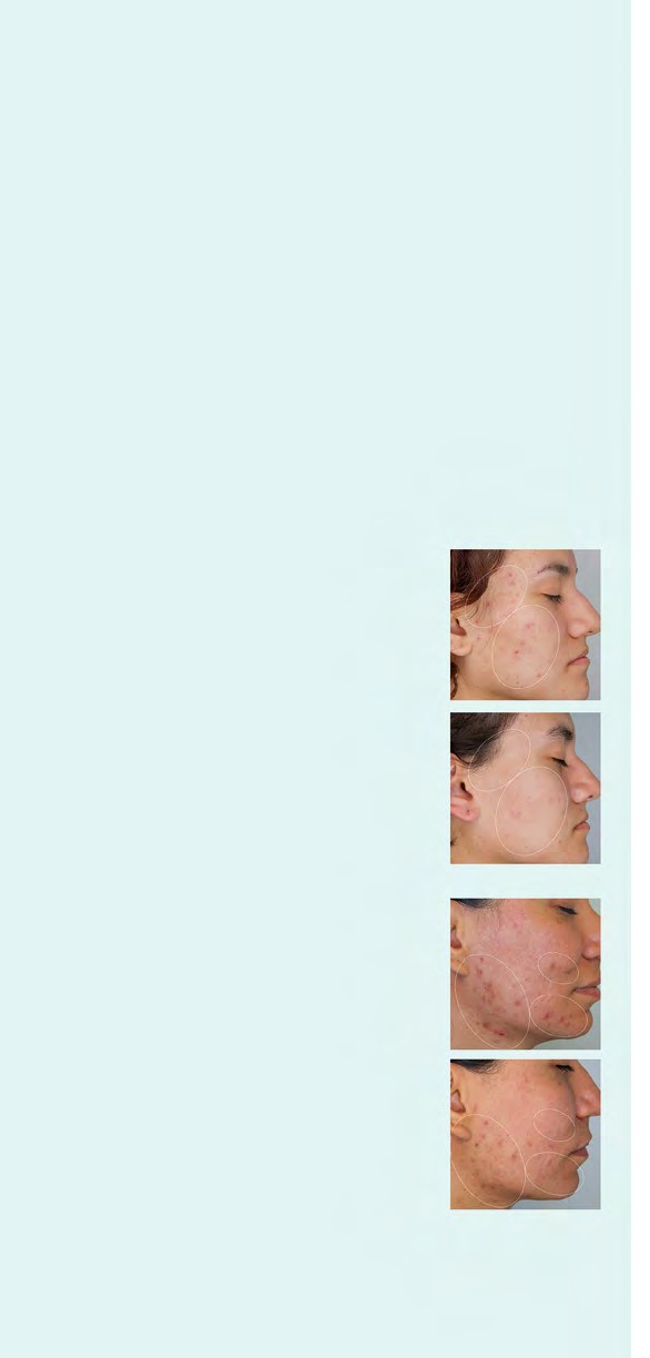 Dermolimpiador Facial (Spot-Specialist)